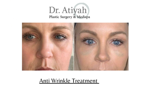 When Should You Consider Anti Wrinkle Treatment in Waterloo?