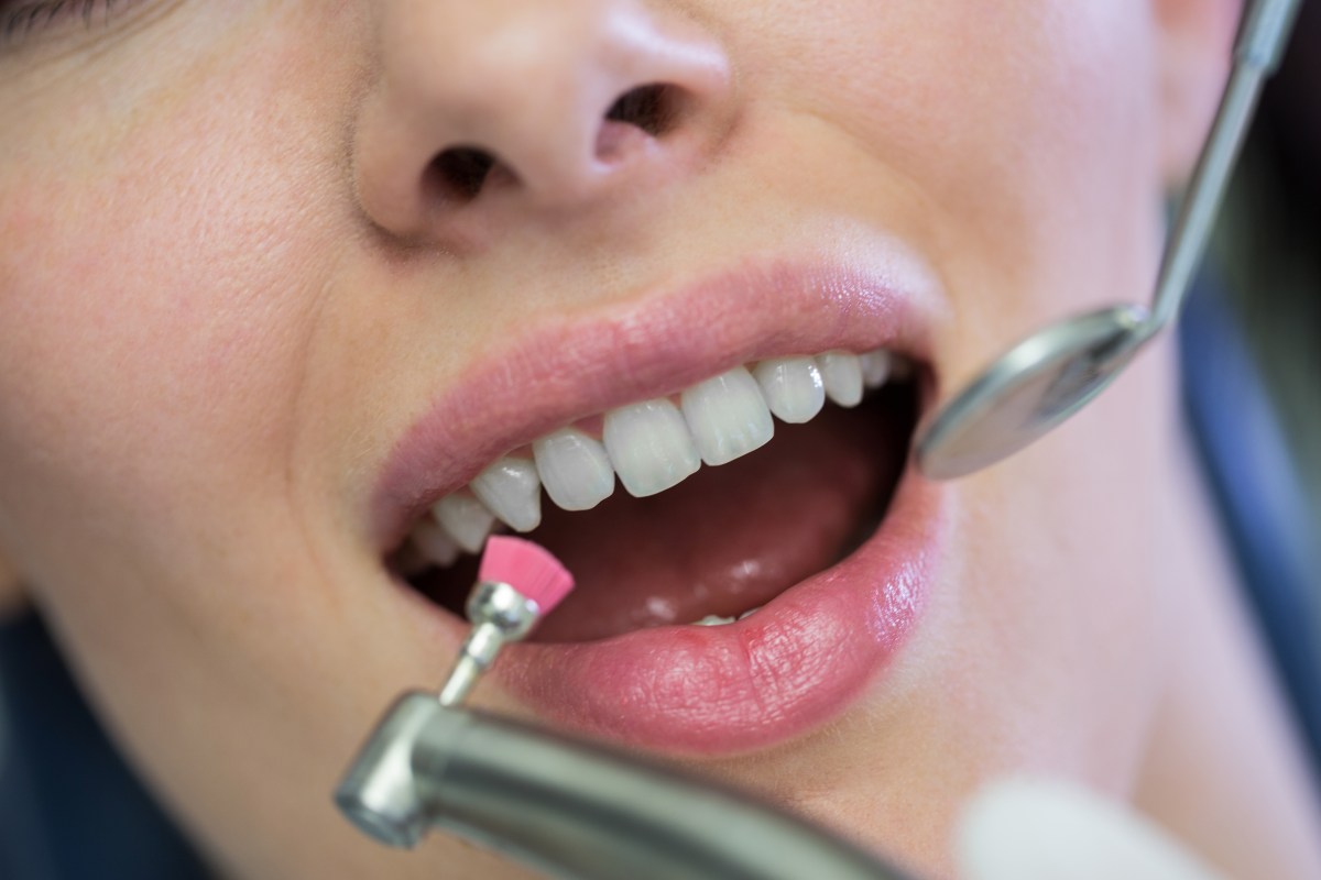 How Do Tooth-Coloured Restorations Repair Damaged or Decayed Teeth? – Sarvesh Health City