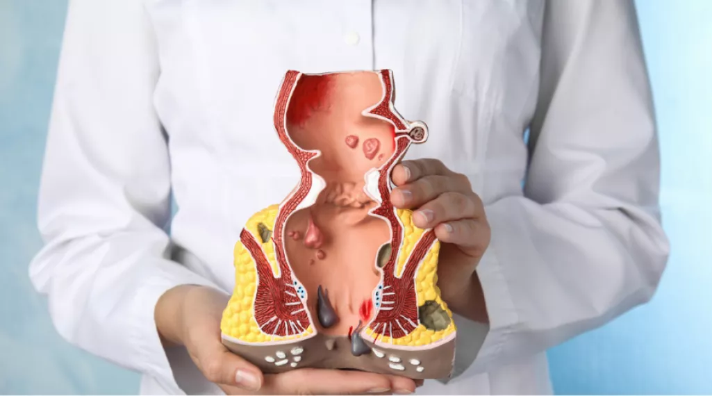 Bleeding Hemorrhoids: Top Treatments and Tips for Quick Relief
