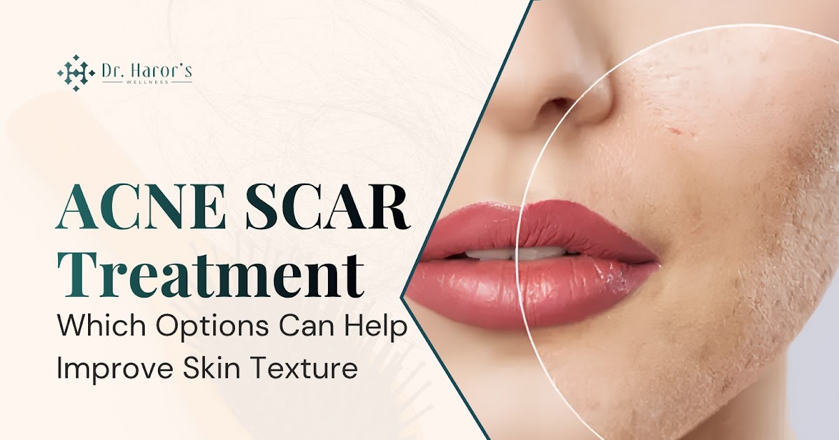 Acne Scar Treatment: Which Options Can Help Improve Skin Texture