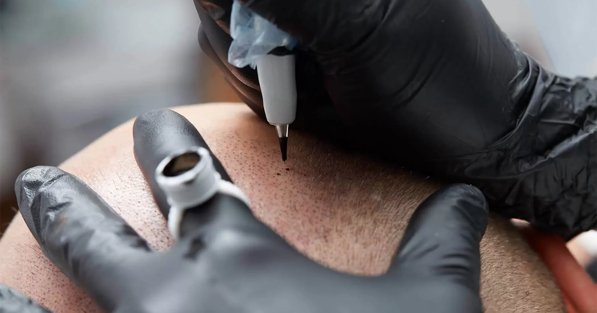 Can Scalp Micropigmentation Improve the Appearance of a Receding Hairline?